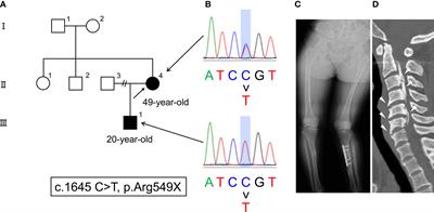 Combined treatment by burosumab and a calcimimetic can ameliorate hypophosphatemia due to excessive actions of FGF23 and PTH in adult XLH with tertiary hyperparathyroidism: A case report